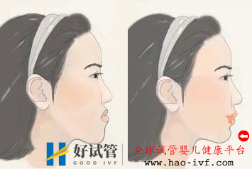 儿童地包天矫正需要多长时间(图2) 儿童地包天矫正需要多长时间(图2)