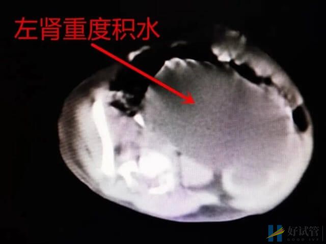 10号染色体微重复出生的宝宝会面临什么结果?(图1) 10号染色体微重复宝宝会出现肾积水