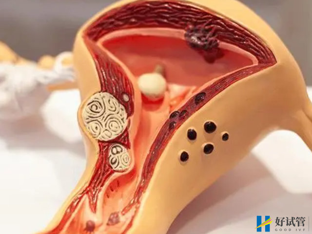 请不要忽略输卵管粘连症状,找到缘由治疗也能怀孕(图2) 输卵管粘连分为三个程度