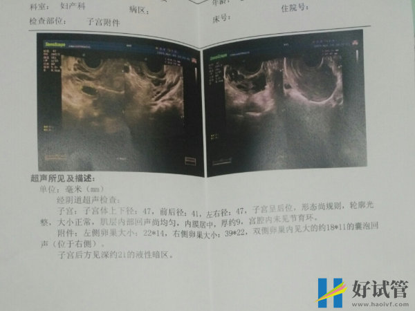 促排B超测优势卵泡的数量有标准,运用方案不同数量则不同(图2) 优势卵泡太多是无需处理的