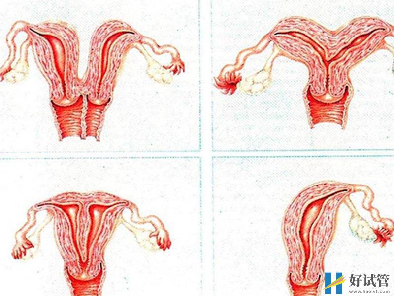 纵隔子宫的原因众多,但多数都是先天性引起的(图1) 纵膈子宫导致原因有先天和后天两种因素
