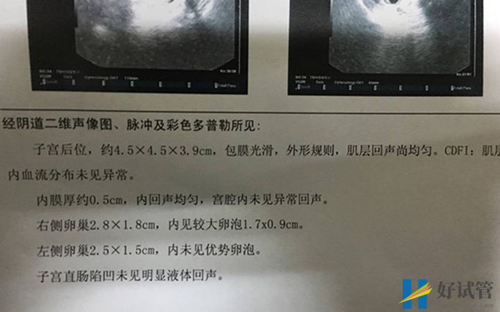 女性卵泡不破不能做试管,找准原因治疗方为上策(图1) 做试管前要先进行b超检查