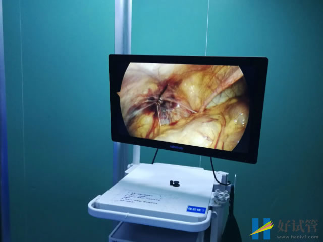 巧克力囊肿早期症状分享,身体出现这些表现要及时就医(图3) 腹腔镜手术可以治疗巧囊