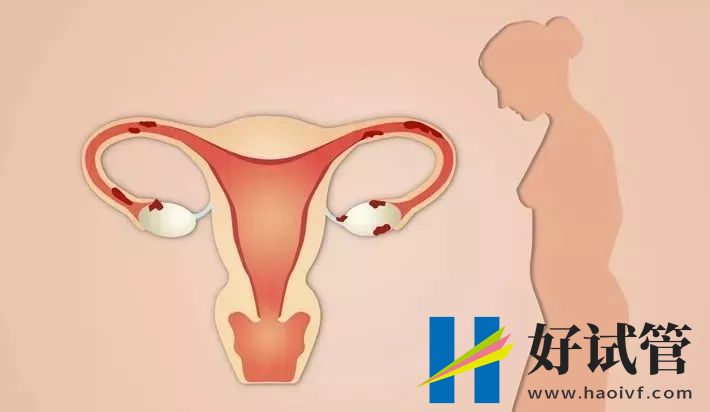 卵巢早衰赴美做试管婴儿,过来人告诉你重视促排卵很重要(图1) 057c93fbe72649d49be2a82bce20feb2.jpeg