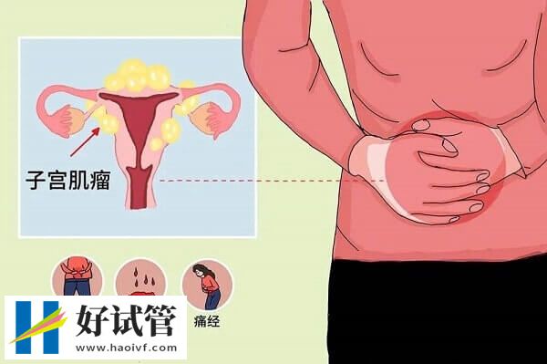 子宫肌瘤是什么原因导致的?(图1) 遗传是导致子宫肌瘤的原因之一