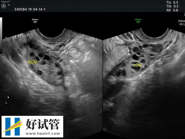 短效长方案的流程(图3) 22b1ed23687ae1b374706e1cd98a66fb_0fGbfjvngg1734494586395.jpeg