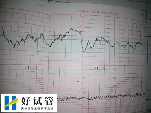 二超的目的是检查胎儿胎心率