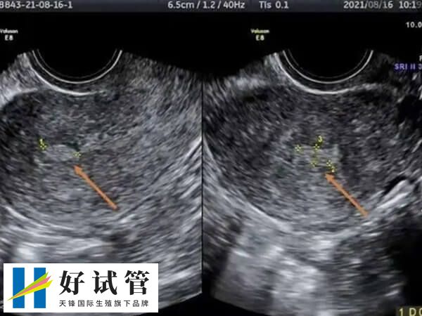 什么情况不能移植鲜胚(图2) 子宫内膜回声不均匀可能存在息肉