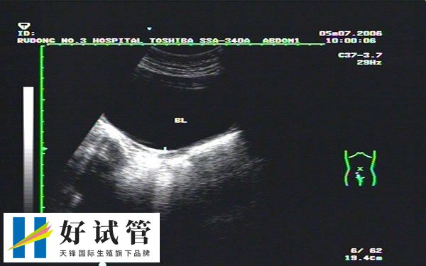 试管移植囊胚预产期怎么算(图2) 超声检查可以确定受精卵的发育情况和大小