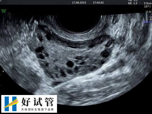 多囊卵巢适不适合微刺激方案(图1) 多囊卵巢是一种常见的内分泌失调疾病