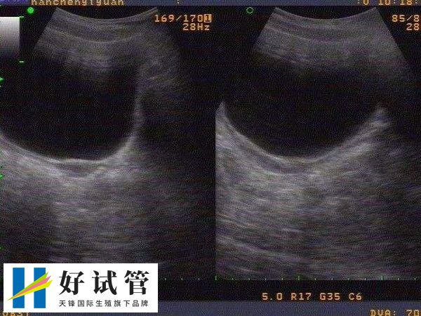 纵隔子宫能不能做试管婴儿(图1) 纵隔子宫可以通过治疗辅助怀孕