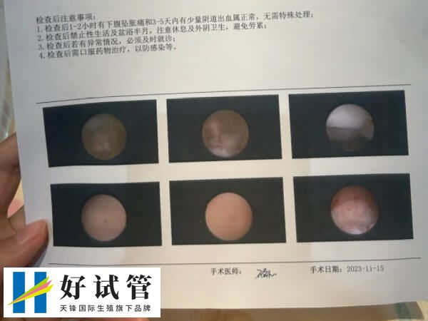 宫腔镜手术后吃坤复康多久(图1) 宫腔镜检查是一种现代医学手段