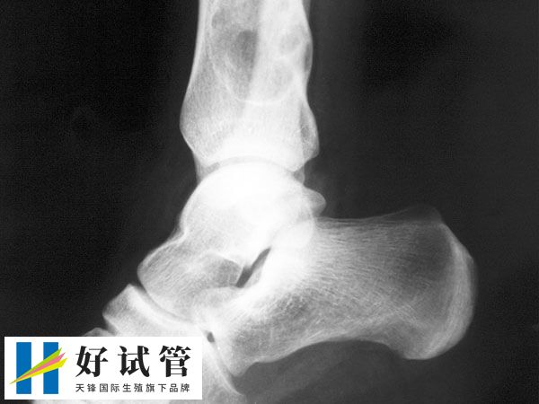 试管婴儿后发现骨肉瘤怎么办(图1) 骨肉瘤是一种高度恶性的骨肿瘤